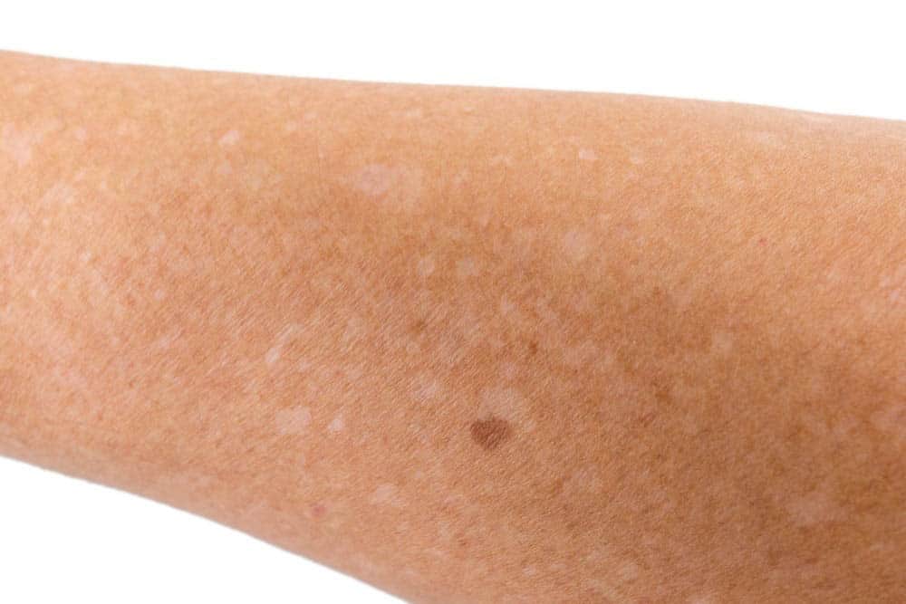 Small White Spots On Skin Little Dots Bumps Face Legs Remedies Treatment