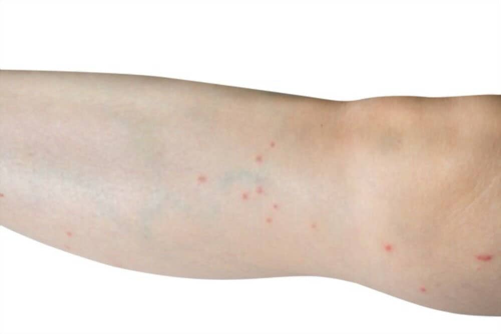 Tiny Red Spots On Skin Bumps Itchy Non Itchy Causes Get Rid Treatment